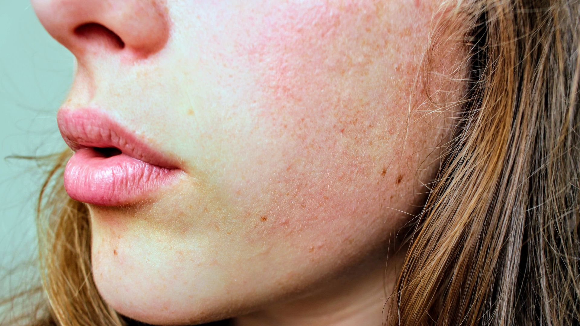 Cómo aliviar la dermatitis atópica, enfermedad inflamatoria crónica de la piel.